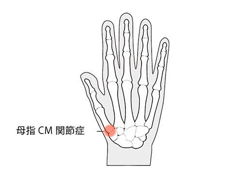 母指CM関節症 物が握りにくい・親指付け根の痛み